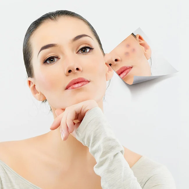 Care for acne-prone skin
